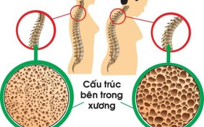 Nguyên nhân, biểu hiện và cách hỗ trợ chữa bệnh loãng xương ở người già