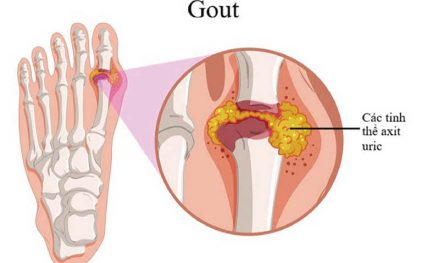 Bệnh Gout (gút): Nguyên nhân và cách điều trị – New Zealand Milk