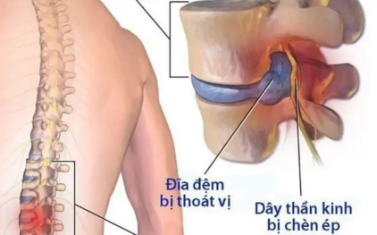 Thoát vị đĩa đệm: Nguyên nhân và cách điều trị hiệu quả – New Zealand Milk